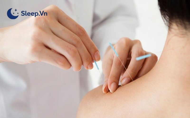 Cách trị mất ngủ bằng châm cứu