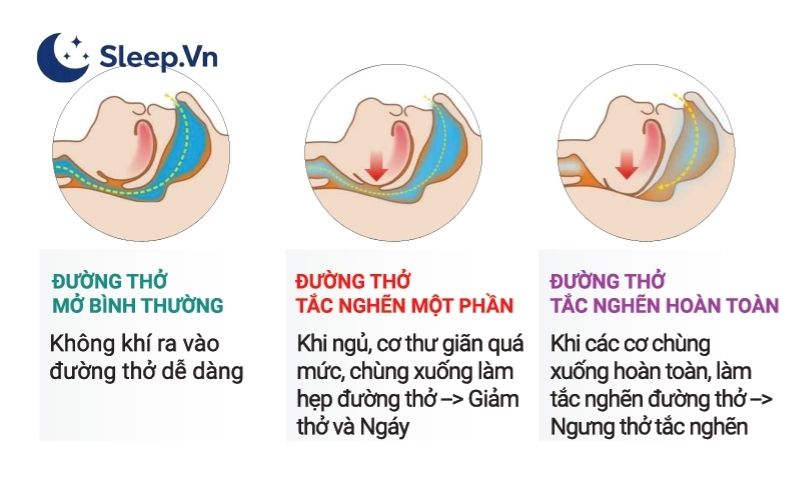 Ngưng thở khi ngủ là tình trạng đường thở bị tắc nghẽn tạm thời trong lúc ngủ
